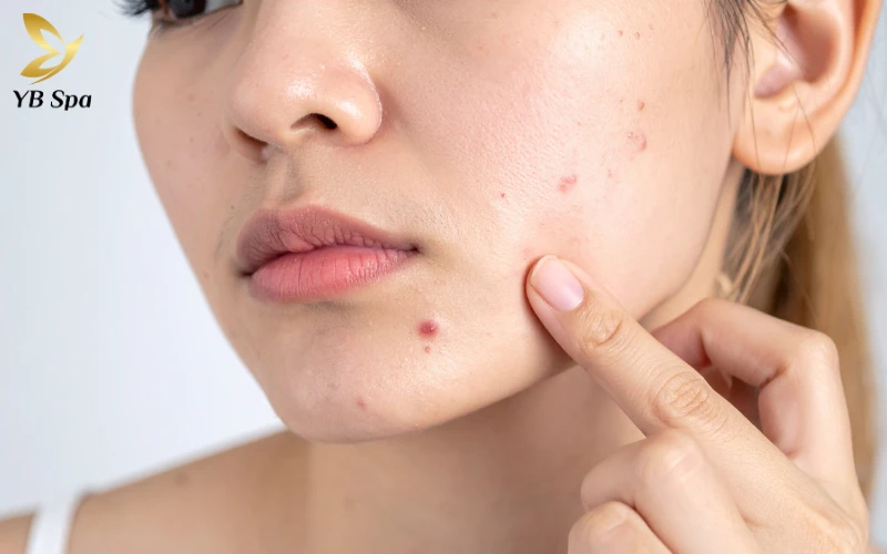 Cách làm xẹp mụn sưng đỏ sau 1 đêm an toàn, cấp tốc 23 Cách làm xẹp mụn sưng đỏ sau 1 đêm an toàn, cấp tốc