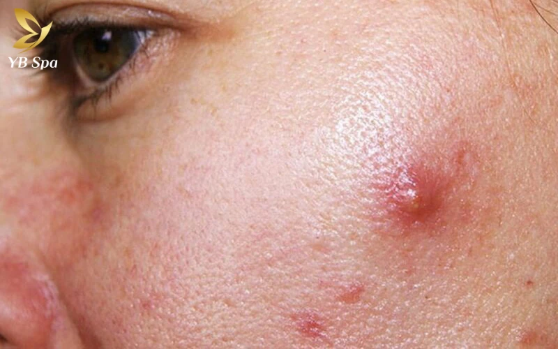 Cách làm xẹp mụn sưng đỏ sau 1 đêm an toàn, cấp tốc 24 Nguyên nhân khiến mụn sưng đỏ hình thành