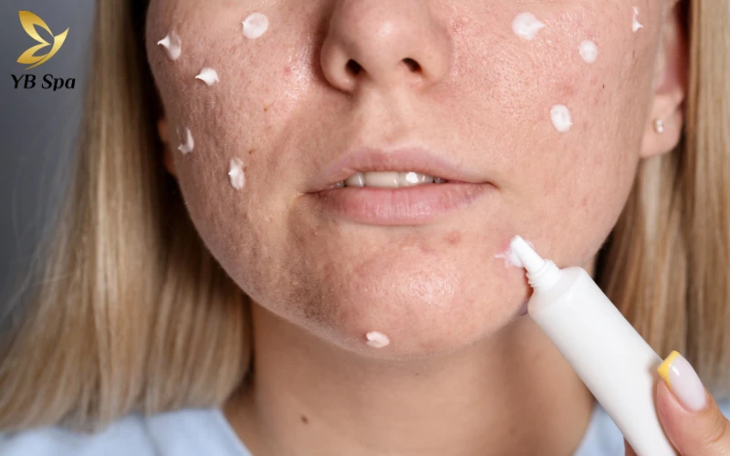 Cách làm xẹp mụn sưng đỏ sau 1 đêm an toàn, cấp tốc 29 Kem Chấm Mụn