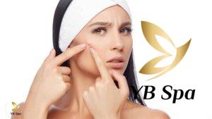 Cách nặn mụn bọc bị chai cứng an toàn đúng chuẩn y khoa