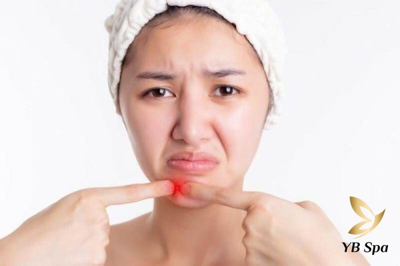 Nặn mụn nhọt ở dưới cằm