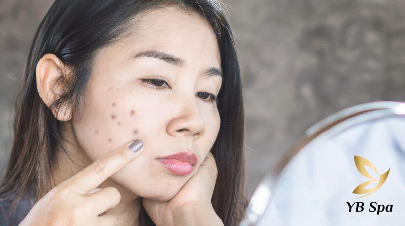 Mụn nhọt để lại các vết thâm trên mặt