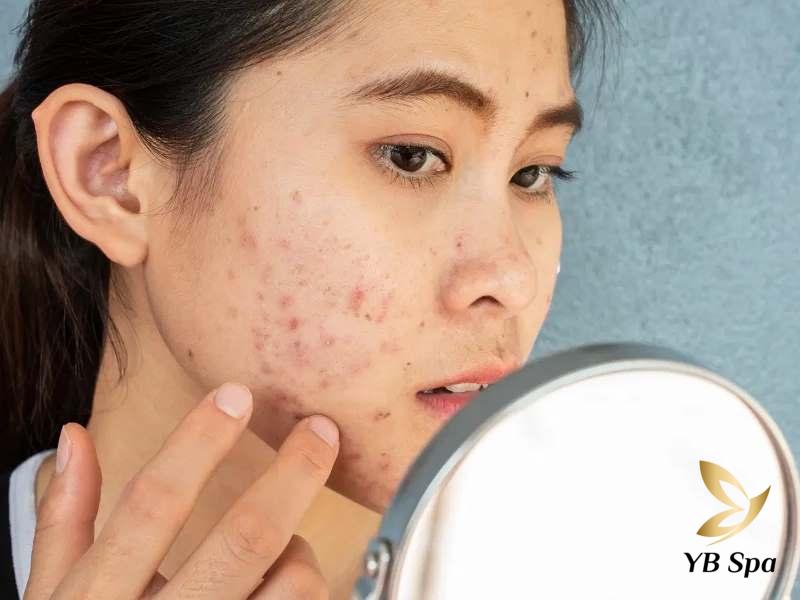 Mụn nhọt ở trên mặt