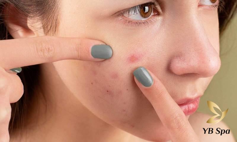 Nặn mụn nhọt ở trên gò má 