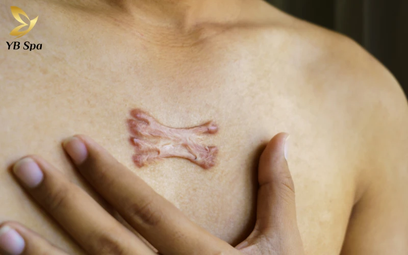 Cách nhận biết cơ địa sẹo lồi