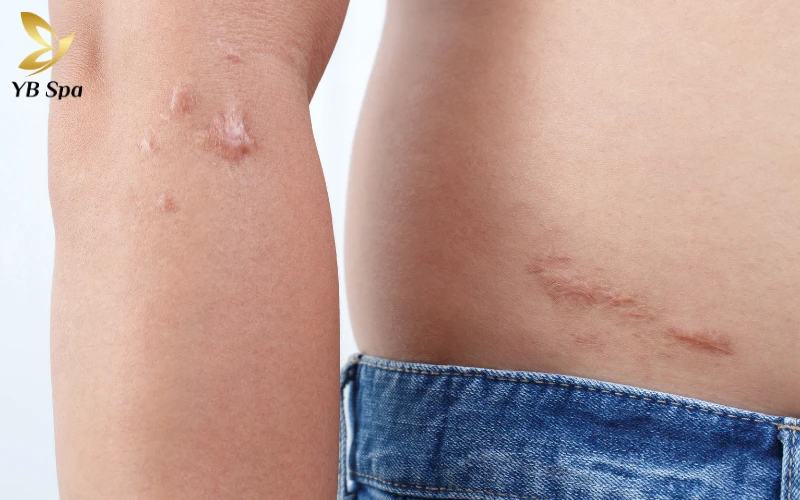 4 Cách nhận biết cơ địa sẹo lồi và cách phòng ngừa 23 Nhận biết cơ địa dễ mắc sẹo lồi Dựa vào tiền sử gia đình (Yếu tố di truyền)