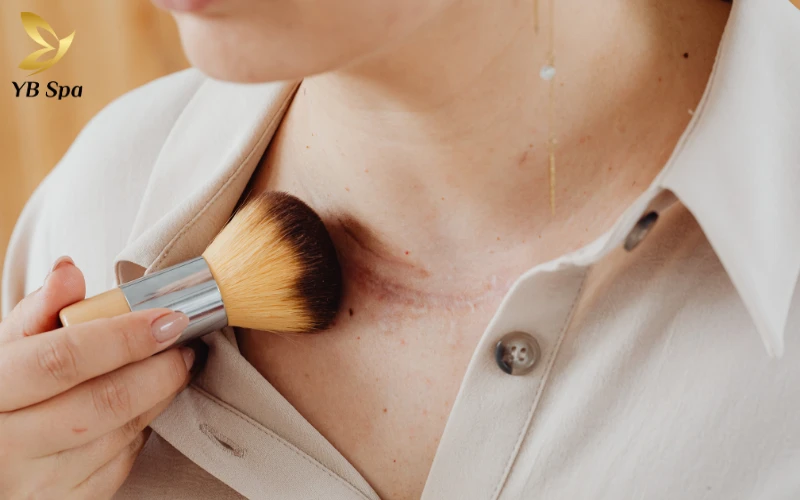 4 Cách nhận biết cơ địa sẹo lồi và cách phòng ngừa 25 sẹo lồi ở cổ