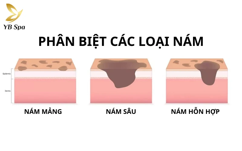 Cách phân biệt các loại nám