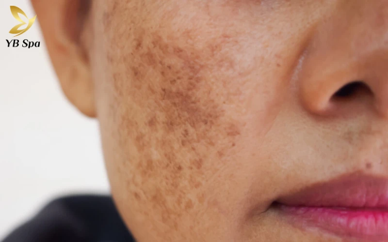 Nám mảng (Epidermal Melasma - Nám Thượng Bì)