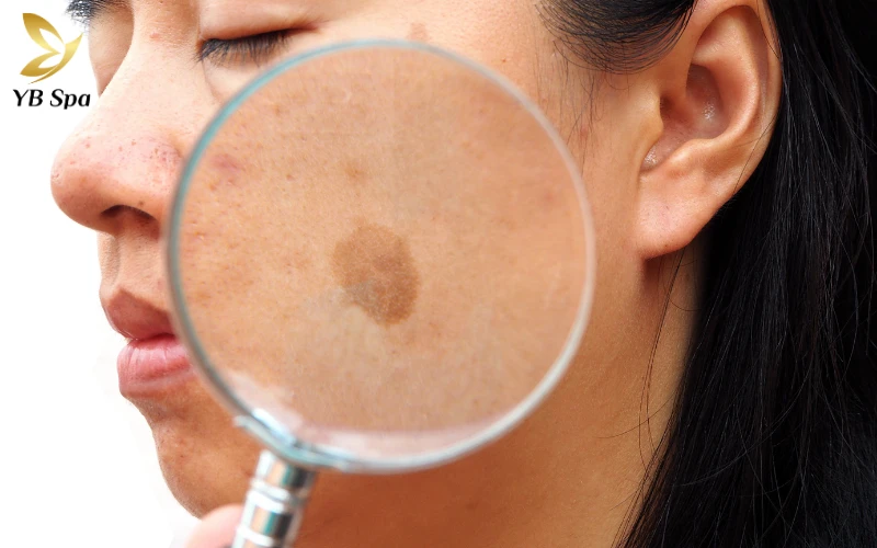 Nám Sâu (Dermal Melasma - Nám Trung Bì)