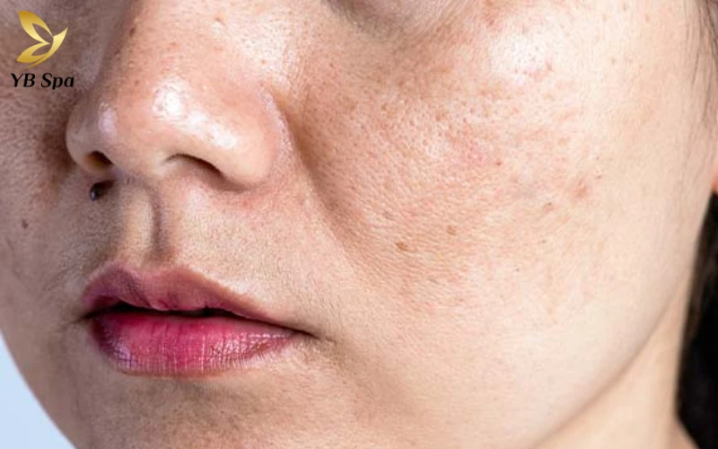 Nám Hỗn Hợp (Mixed Melasma)