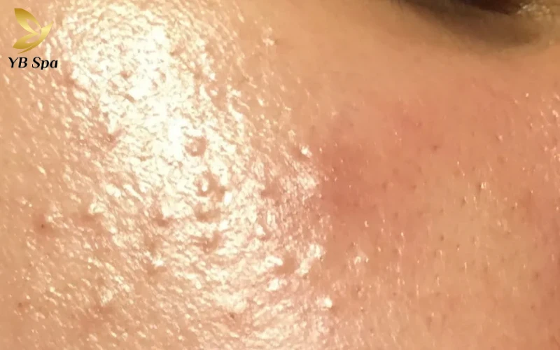 Quy trình 7 bước trị mụn ẩn cho da dầu tại nhà 12 cách trị mụn ẩn cho da dầu - Khám phá ngay 7 bước trị mụn ẩn chuẩn y khoa tại nhà để sở hữu làn da khỏe mạnh và mịn màng bền vững.