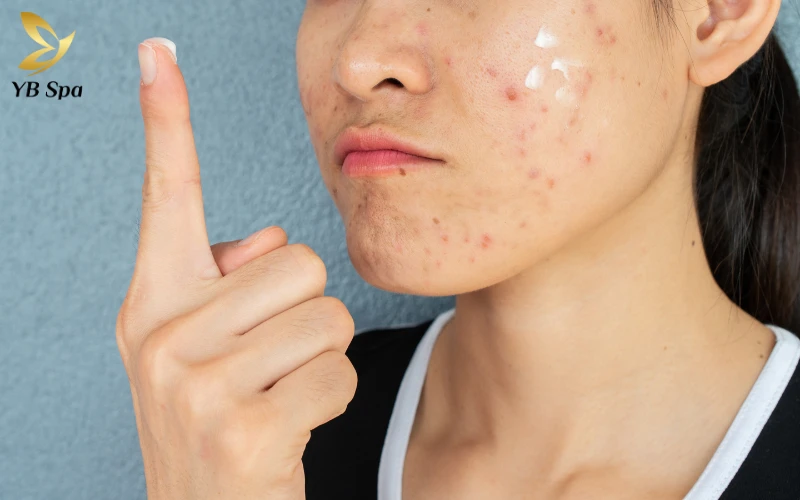 Quy trình 7 bước trị mụn ẩn cho da dầu tại nhà 17 Các hoạt chất đặc trị mạnh mẽ giúp đẩy nhân mụn ẩn và tiêu diệt vi khuẩn, ngăn chặn hiệu quả nguy cơ mụn chuyển viêm.