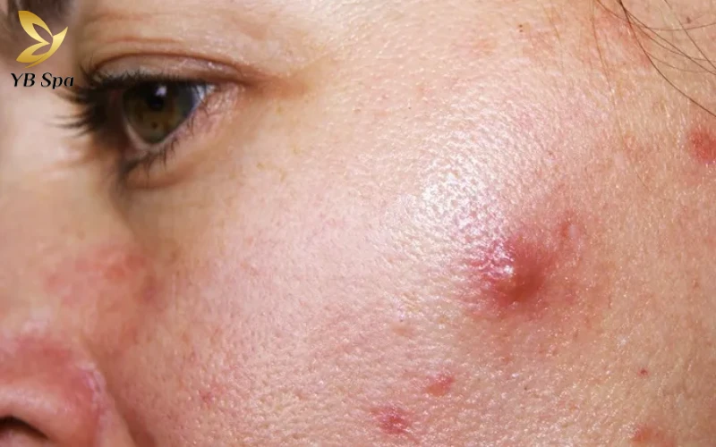 6 cách trị mụn bọc cho da nhờn, giảm sưng trong 24 giờ 10 Đừng để mụn bọc để lại sẹo - khám phá cách trị mụn bọc cho da nhờn và cắt đứt chu kỳ viêm từ YB Spa.