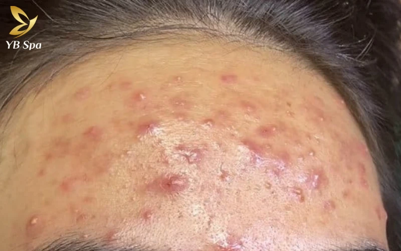 6 cách trị mụn bọc cho da nhờn, giảm sưng trong 24 giờ 11 Dầu thừa kết hợp với tế bào chết tạo thành những "nút thắt" bít tắc, biến lỗ chân lông thành một ổ viêm tiềm tàng.