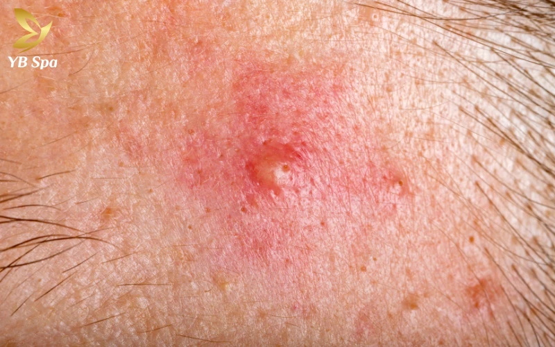 Cách trị mụn bọc nhanh nhất trong 1 đêm an toàn và khoa học 26 Cách trị mụn bọc nhanh nhất trong 1 đêm an toàn và khoa học