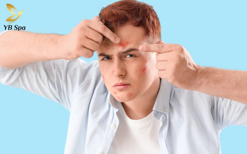 Cách trị mụn bọc nhanh nhất trong 1 đêm an toàn và khoa học 37 Nặn mụn bừa bãi khi mụn chưa chín