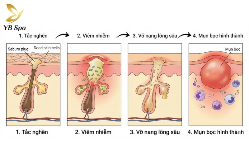 Cách trị mụn bọc nhanh nhất trong 1 đêm an toàn và khoa học 28 Tắc nghẽn lỗ chân lông và sự tấn công của vi khuẩn