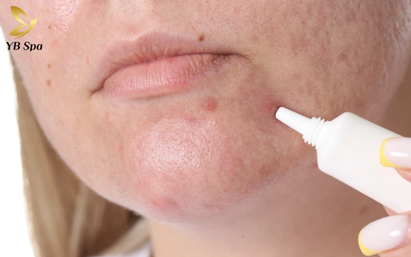 Cách trị mụn bọc nhanh nhất trong 1 đêm an toàn và khoa học 33 Kem chấm mụn chứa Benzoyl Peroxide hoặc Salicylic Acid (BHA)