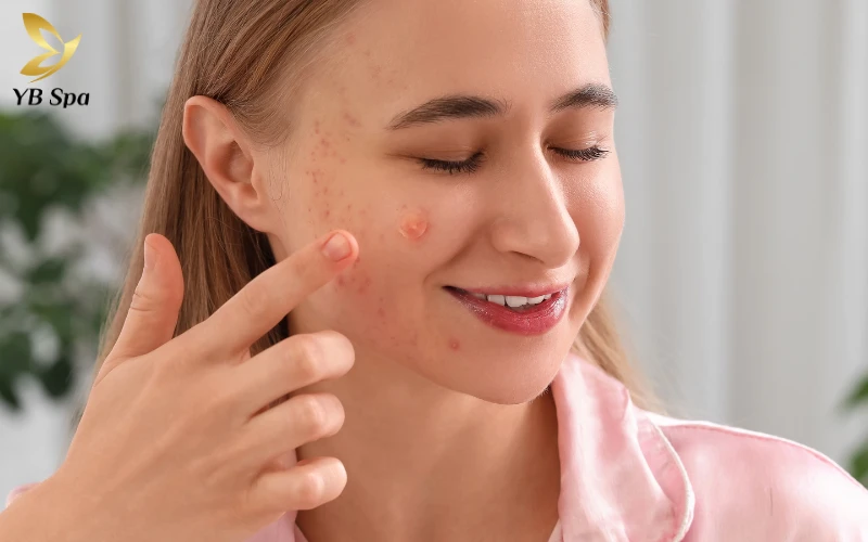 Miếng dán trị mụn - Giải pháp bảo vệ và hút mủ