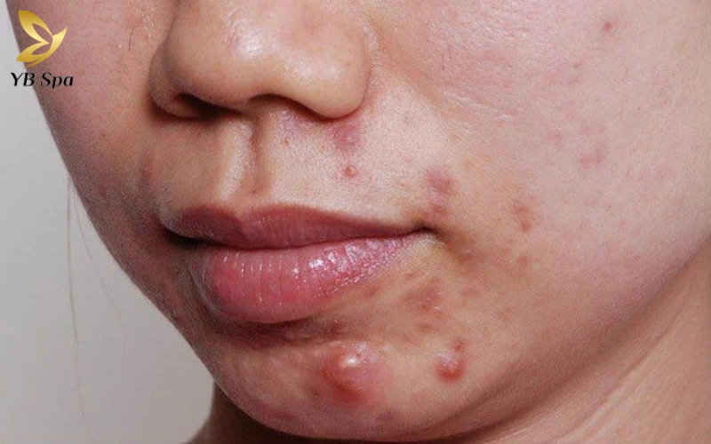 16+ Cách trị mụn bọc ở cằm tại nhà hiệu quả từ thiên nhiên 13 Đừng để mụn bọc ở cằm làm đau nhức và mất tự tin, thử ngay những cách xử lý an toàn tại nhà để da sớm mịn màng trở lại