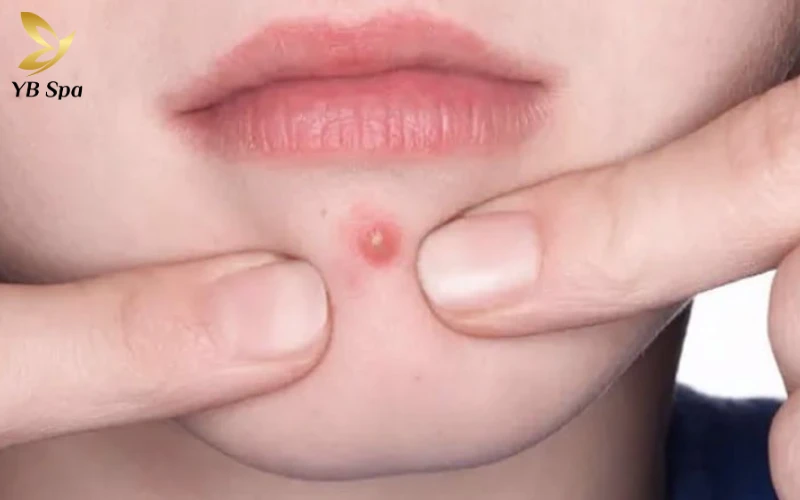 16+ Cách trị mụn bọc ở cằm tại nhà hiệu quả từ thiên nhiên 23 Nặn mụn khi nhân chưa chín là con đường ngắn nhất dẫn đến những vết sẹo lõm vĩnh viễn và tổn thương sâu lớp hạ bì