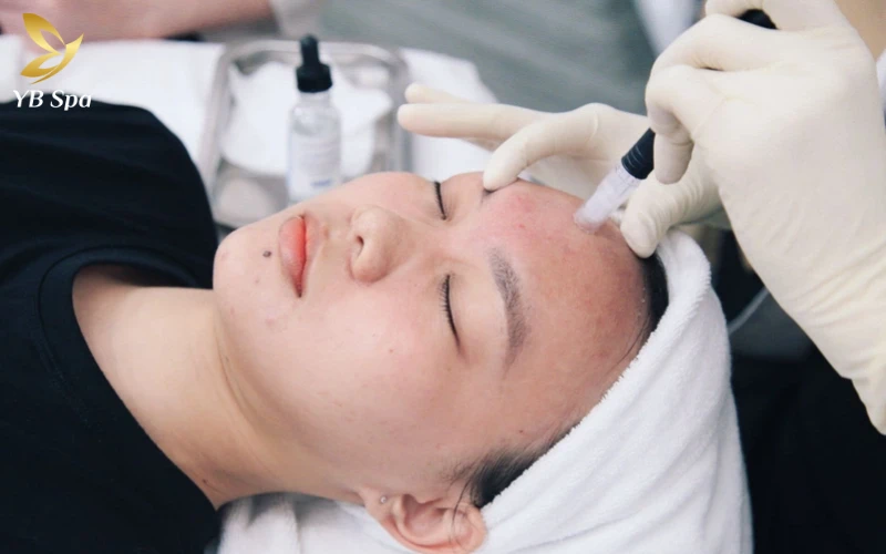 Cách Trị Mụn Bọc Ở Trán Hiệu Quả, Nhanh Lành 25 Liệu Trình MESO Trị Mụn – Phục Hồi Da Chuyên Sâu