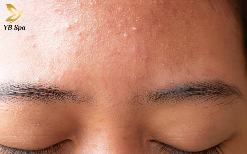 Cách Trị Mụn Cám Ở Trán Nhanh Và Hiệu Quả