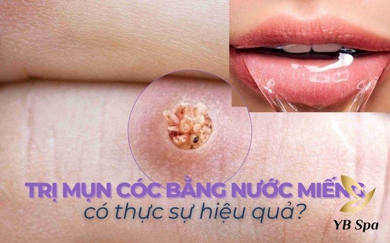 Tìm hiểu cách trị mụn cóc bằng nước miếng có thật sự hiệu quả?
