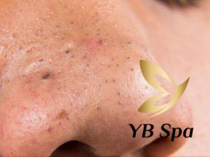 Mụn đầu đen ở mũi là gì? Top 11 cách trị mụn đầu đen ở mũi