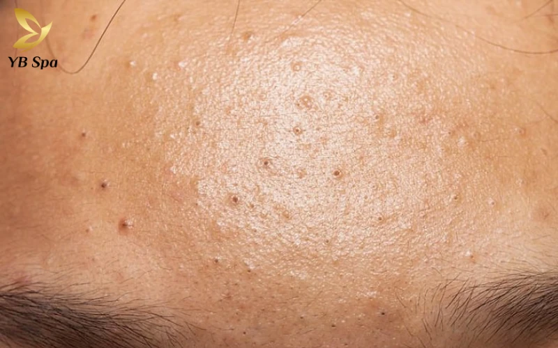 Cách Trị Mụn Đầu Đen Trên Trán Tại Nhà