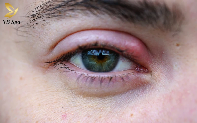 Mụn lẹo là gì?