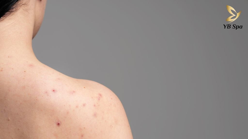 Cách trị mụn lưng hiệu quả sau 7 ngày 19 Cach Tri Mun Lung 1