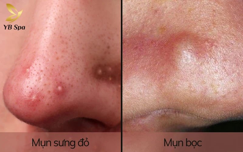 Cách trị mụn sưng đỏ ở mũi nhanh, an toàn, không để lại thâm sẹo 25 Cách trị mụn sưng đỏ ở mũi nhanh, an toàn, không để lại thâm sẹo