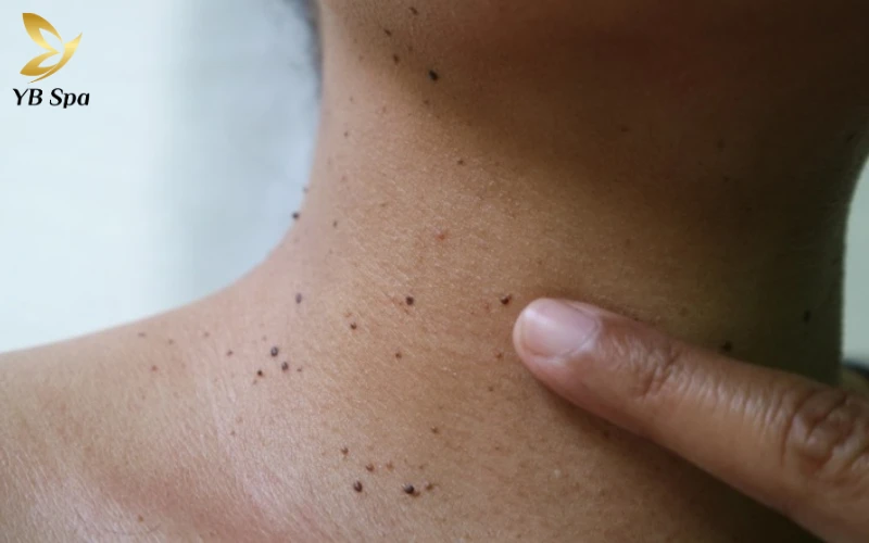 mụn thịt ở cổ