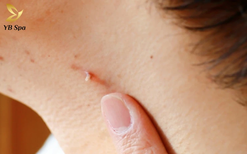 Mụn thịt ở cổ là gì