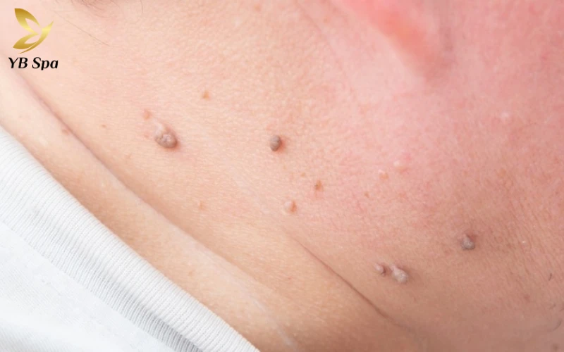 Mụn thịt ở cổ do Ma sát thường xuyên