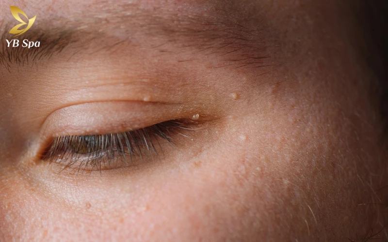 Cách trị mụn thịt quanh mắt an toàn và hiệu quả tại nhà