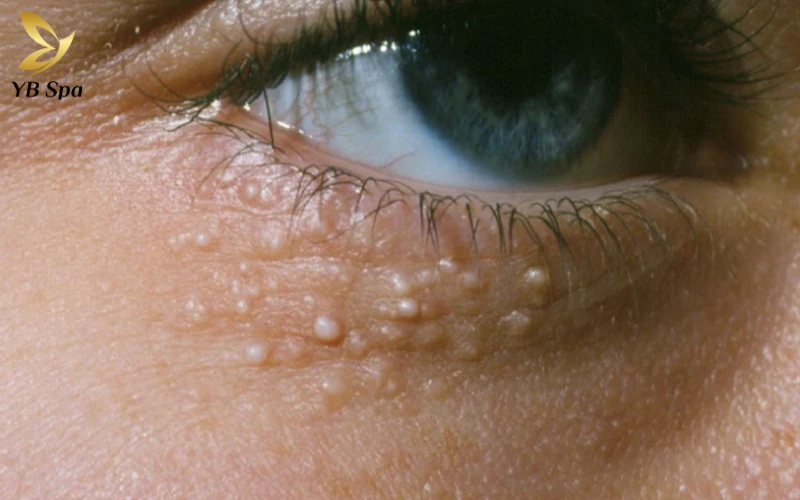 Nguyên nhân gây ra mụn thịt quanh mắt - Tích tụ keratin dưới da