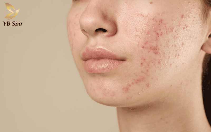 Bảo vệ làn da khỏi biến chứng sẹo rỗ với phương pháp trị mụn viêm an toàn được thiết kế riêng bởi đội ngũ chuyên gia YB Spa
