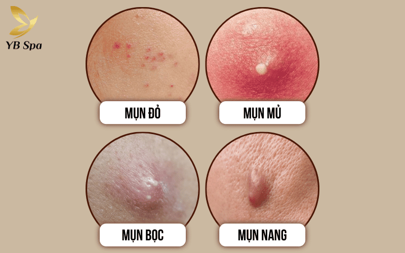 Nhận diện đúng 4 loại mụn viêm phổ biến là bước đầu tiên quan trọng để bạn chọn phương pháp điều trị hiệu quả và tránh để lại sẹo