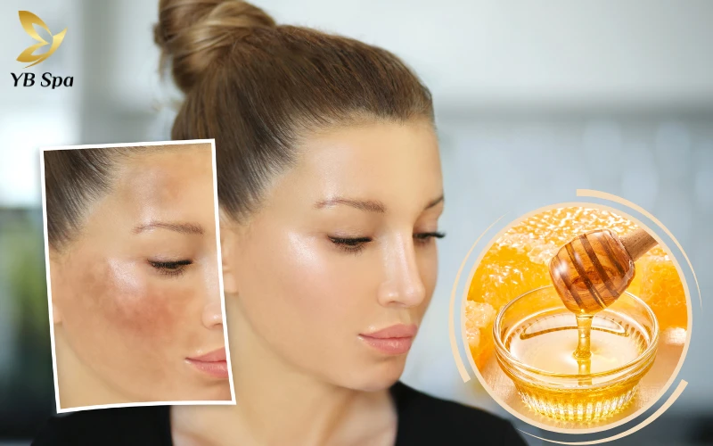 Cách trị nám bằng mật ong hiệu quả và an toàn tại nhà