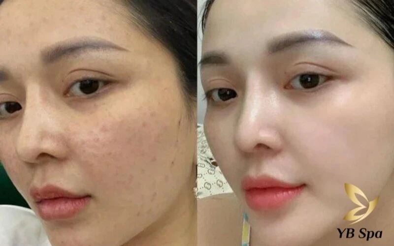 Liệu trình Mesotherapy – Cấy tinh chất trắng sáng