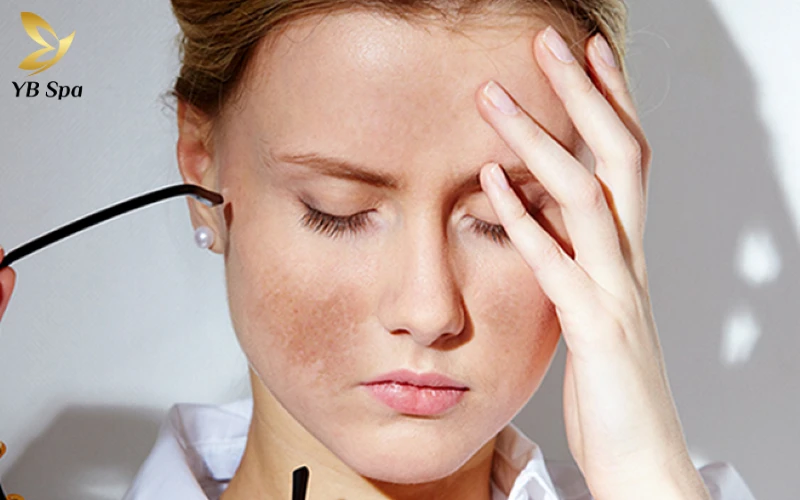 8 Cách trị nám gò má tại nhà hiệu quả, an toàn