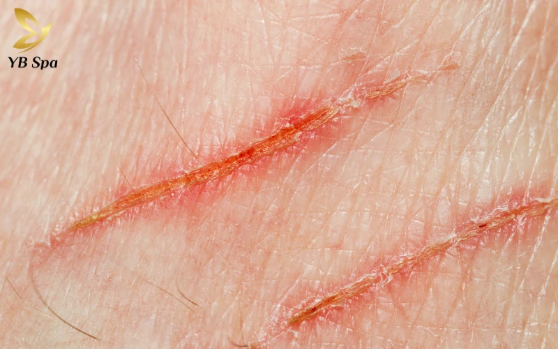 tổn thương cấu trúc da 