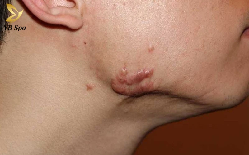 Cách trị sẹo lồi trên mặt hiệu quả từ thiên nhiên đến công nghệ cao 26 Cách trị sẹo lồi trên mặt hiệu quả từ thiên nhiên đến công nghệ cao