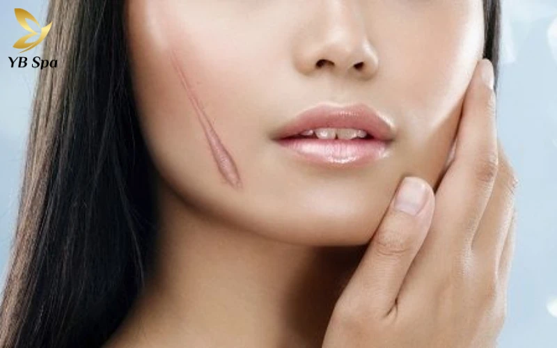 Sẹo lồi trên mặt