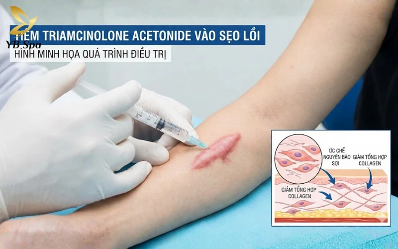 Cách trị sẹo lồi trên mặt hiệu quả từ thiên nhiên đến công nghệ cao 34 Tiêm Corticosteroid