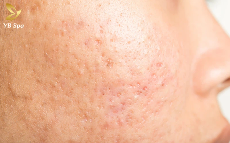 5 Cách trị sẹo lõm lâu năm tại nhà an toàn từ thiên nhiên 25 Sẹo lõm lâu năm có tự phục hồi được không?