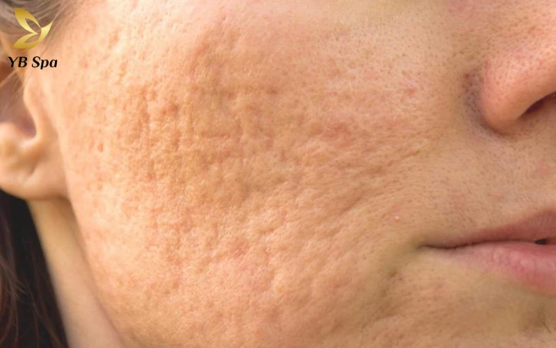 Cách trị sẹo rỗ tại nhà hiệu quả